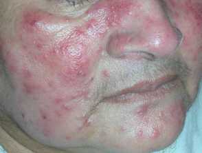 example-of-rosacea-on-face